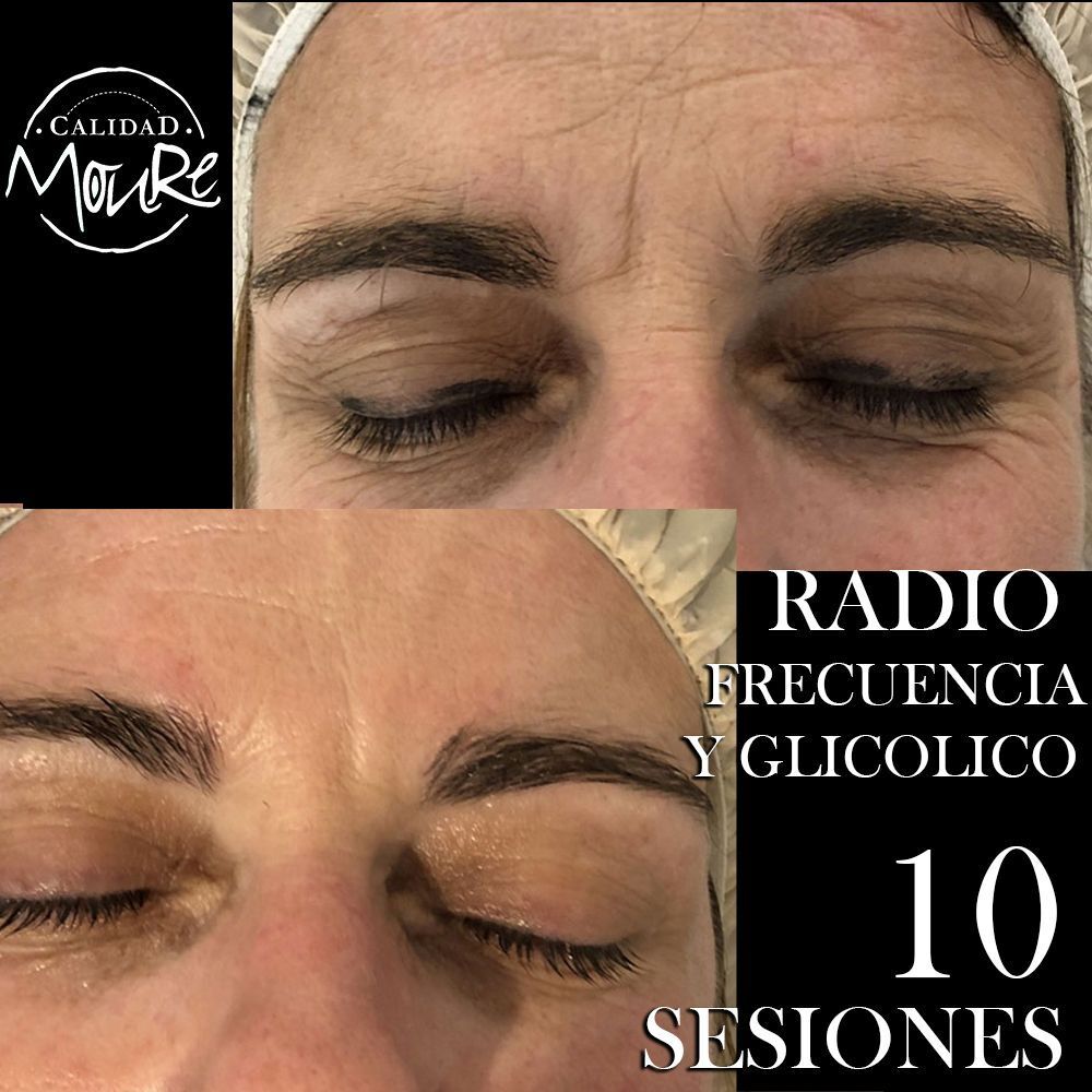 RADIOFRECUENCIA LASER GALVANICA Y ACIDO HIALURONICO CENTRO DE ESTETICA MOURE MALLORCA (7)