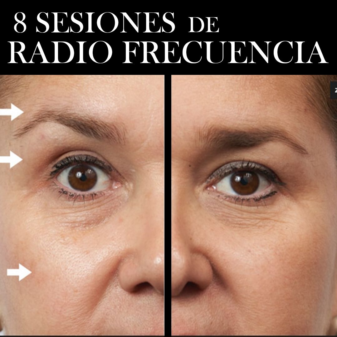 RADIOFRECUENCIA LASER GALVANICA Y ACIDO HIALURONICO CENTRO DE ESTETICA MOURE MALLORCA (8)