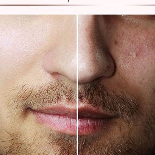 TRATAMIENTO FACIAL HOMBRE ANTES Y DESPUES BARBERIA PELUQUERIA MALLORCA MOURE (10)