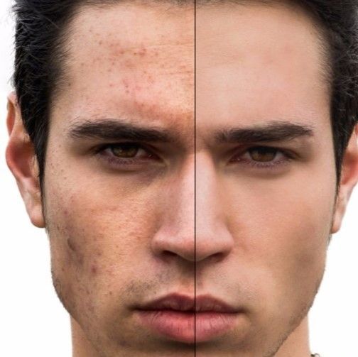 TRATAMIENTO FACIAL HOMBRE ANTES Y DESPUES BARBERIA PELUQUERIA MALLORCA MOURE (2)