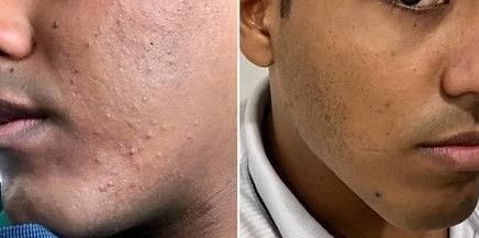 ACNE EN LA CARA ANTES Y DESPUES (10)