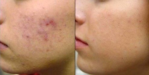 ACNE EN LA CARA ANTES Y DESPUES (12)