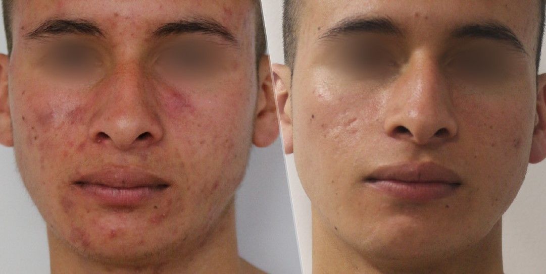 ACNE EN LA CARA ANTES Y DESPUES (13)