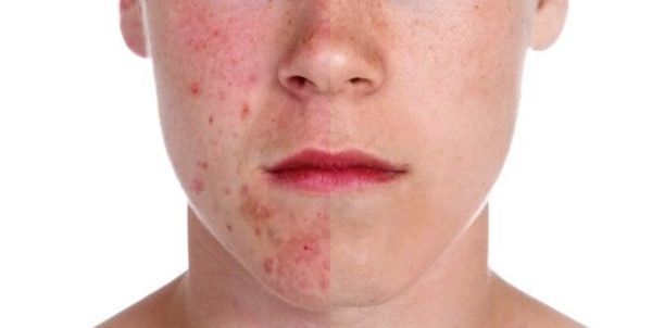 ACNE EN LA CARA ANTES Y DESPUES (16)