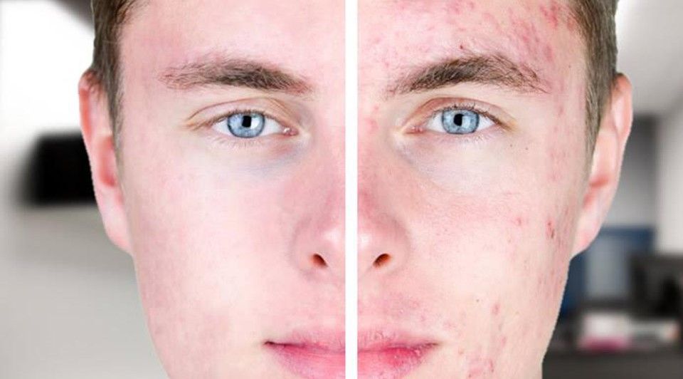 ACNE EN LA CARA ANTES Y DESPUES (17)