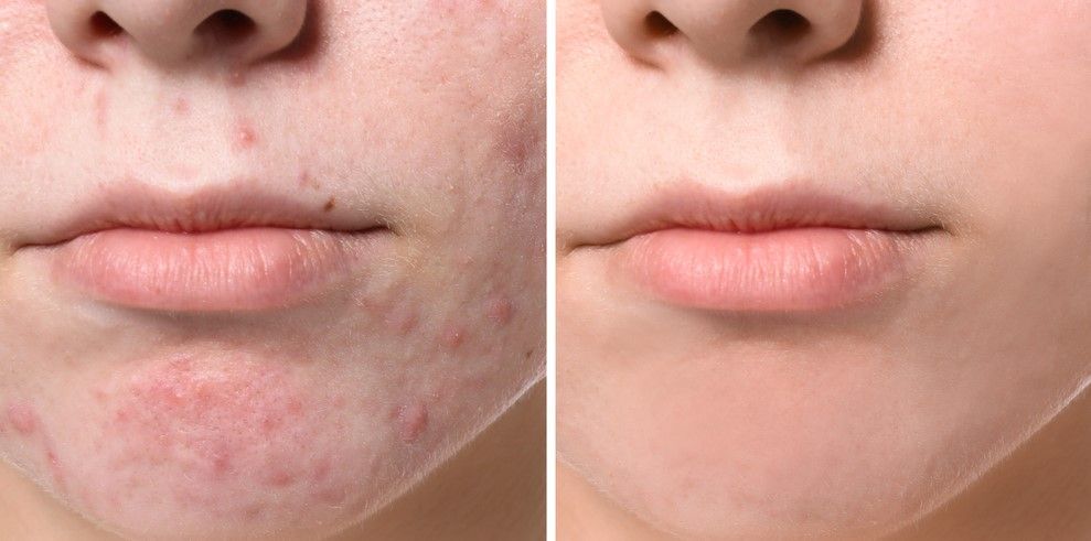 ACNE EN LA CARA ANTES Y DESPUES CENTROS MOURE MALLORCA (22)