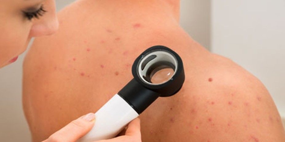 TRATAMIENTO DE ACNE EN LA ESPALDA MALLORCA CENTROS MOURE (10)