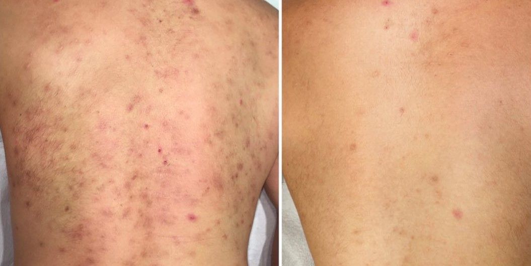 TRATAMIENTO DE ACNE EN LA ESPALDA MALLORCA CENTROS MOURE (12)
