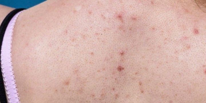 TRATAMIENTO DE ACNE EN LA ESPALDA MALLORCA CENTROS MOURE (16)