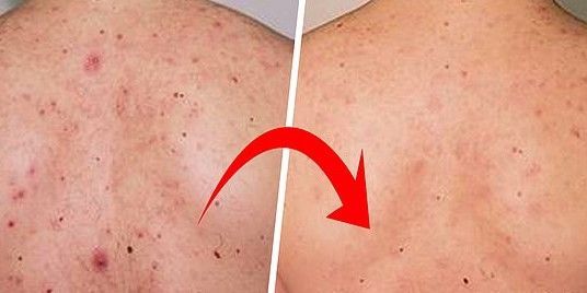 TRATAMIENTO DE ACNE EN LA ESPALDA MALLORCA CENTROS MOURE (6)