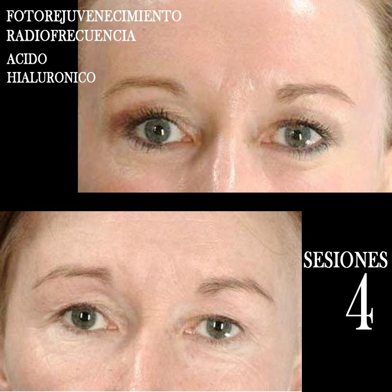 TRATAMIENTO FOTOREJUVENECIMIENTO FACIAL CENTROS MOURE MALLORCA (3)