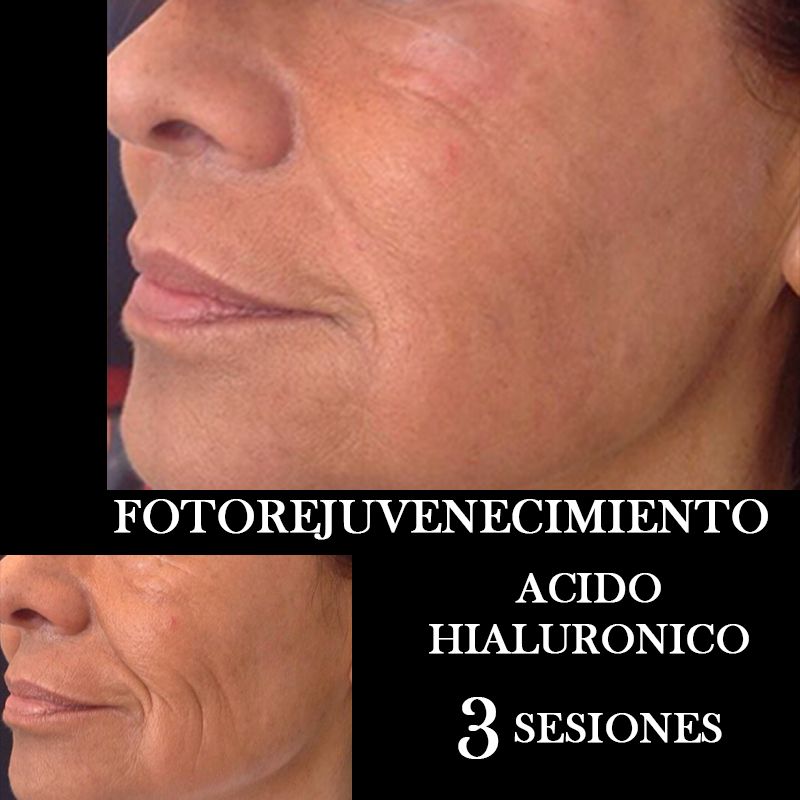 TRATAMIENTO FOTOREJUVENECIMIENTO FACIAL CENTROS MOURE MALLORCA (6)