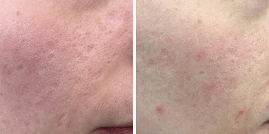 TRATAMIENTO PARA QUITAR MARCAS DE ACNE (1)