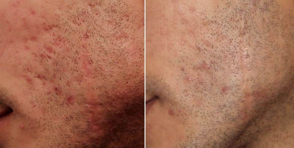 RATAMIENTO PARA QUITAR MARCAS DE ACNE (4)