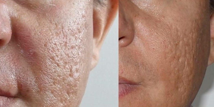 TRATAMIENTO PARA QUITAR MARCAS DE ACNE (7)