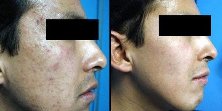 TRATAMIENTO PARA QUITAR MARCAS DE ACNE (8)