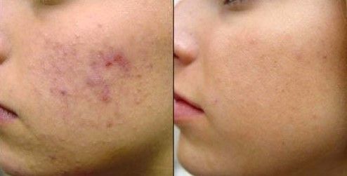 TRATAMIENTO PARA QUITAR MARCAS DE ACNE (9)