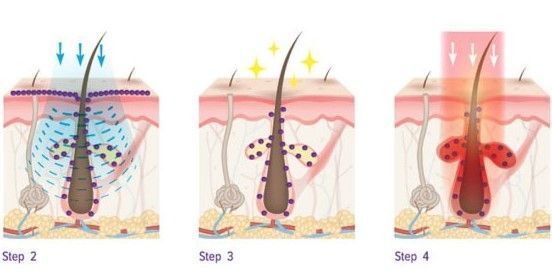 TRATAMIENTOS PIEL ACNEICA EN CENTROS MOURE PALMA DE MALLORCA (14)