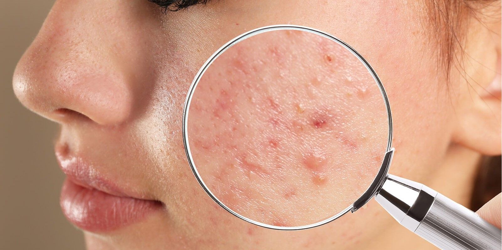 TRATAMIENTOS PIEL ACNEICA EN CENTROS MOURE PALMA DE MALLORCA (18)