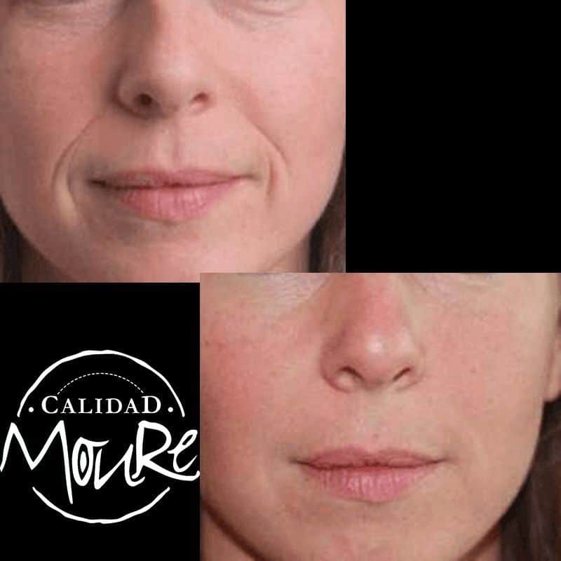 ACIDO HIALURONICO ENTRECEJO NASOJENIANO, OJOS CENTROS MOURE MALLORCA (12)