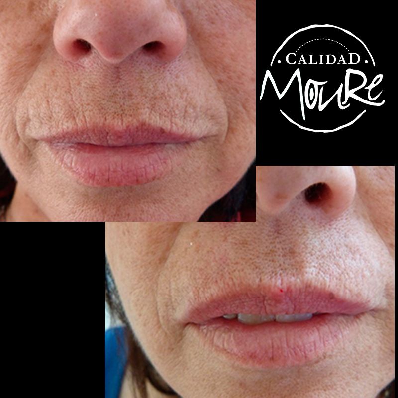 ACIDO HIALURONICO ENTRECEJO NASOJENIANO, OJOS CENTROS MOURE MALLORCA (3)