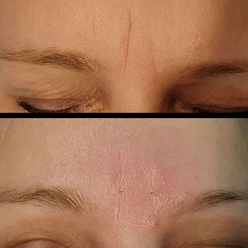 ACIDO HIALURONICO ENTRECEJO NASOJENIANO, OJOS CENTROS MOURE MALLORCA (6)