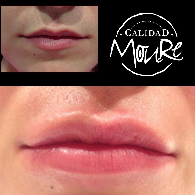 ACIDO HIALURONICO, HIALUROPEN, CENTRO DE ESTETICA MOURE MALLORCA, RELLENO (1)