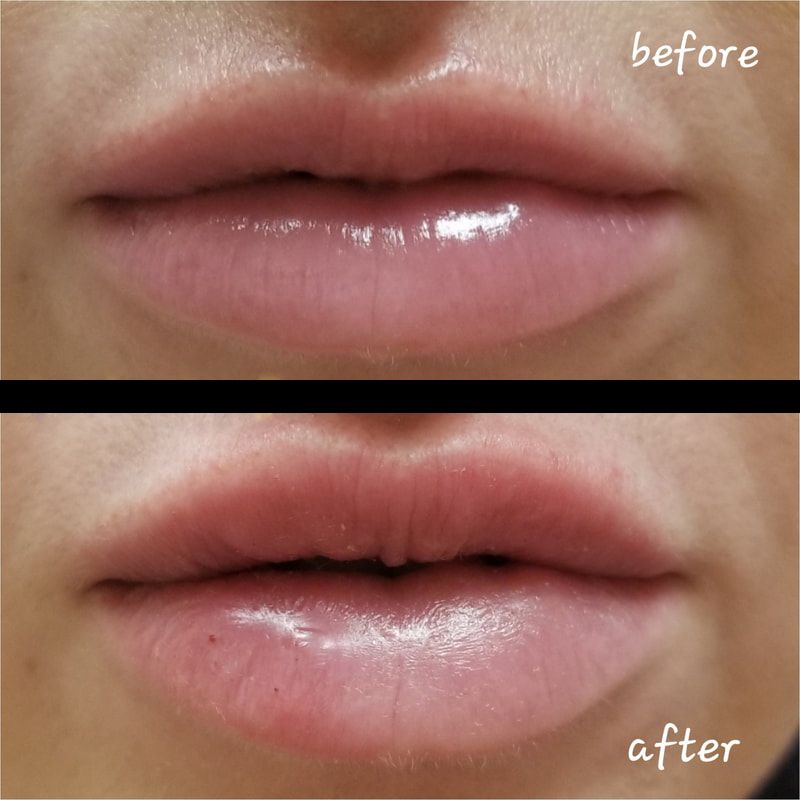 ACIDO HIALURONICO, HIALUROPEN, CENTRO DE ESTETICA MOURE MALLORCA, RELLENO (11)