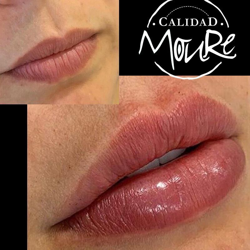 ACIDO HIALURONICO, HIALUROPEN, CENTRO DE ESTETICA MOURE MALLORCA, RELLENO (12)