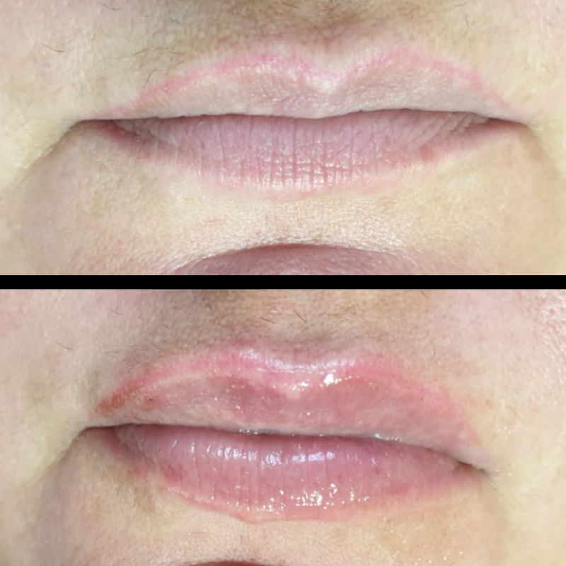 ACIDO HIALURONICO, HIALUROPEN, CENTRO DE ESTETICA MOURE MALLORCA, RELLENO (14)