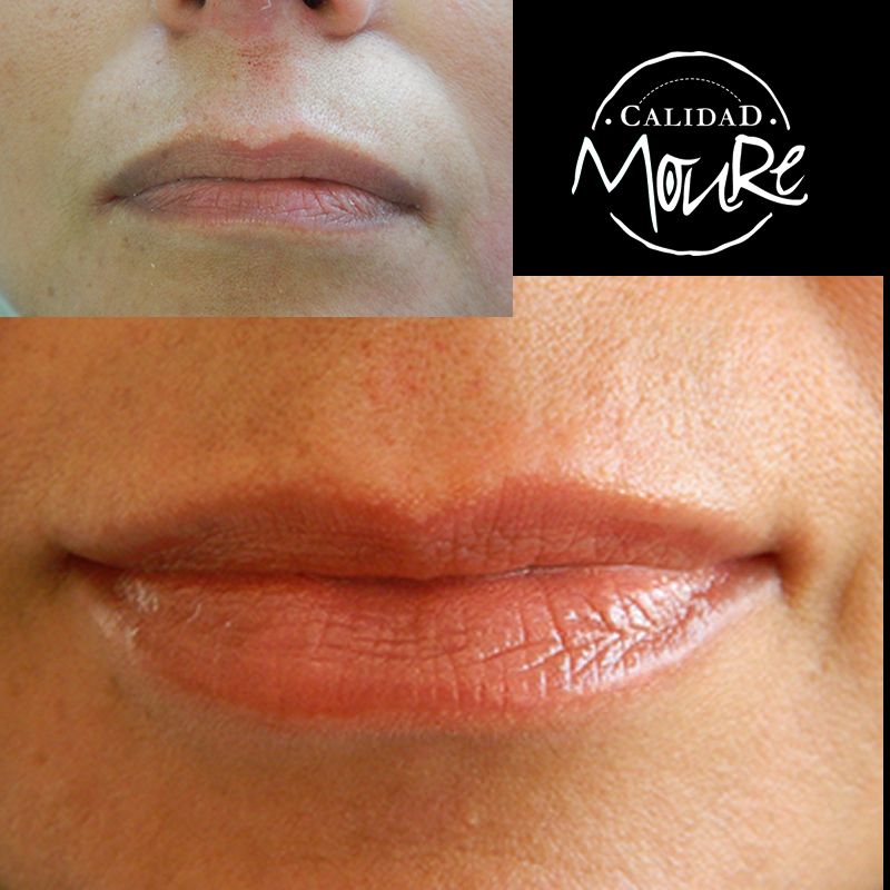 ACIDO HIALURONICO, HIALUROPEN, CENTRO DE ESTETICA MOURE MALLORCA, RELLENO (2)