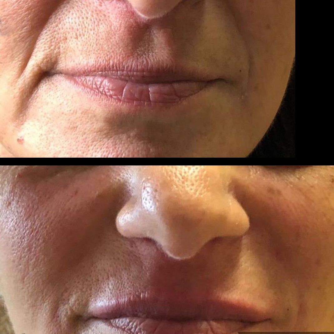 ACIDO HIALURONICO, HIALUROPEN, CENTRO DE ESTETICA MOURE MALLORCA, RELLENO (4)