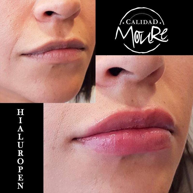 ACIDO HIALURONICO, HIALUROPEN, CENTRO DE ESTETICA MOURE MALLORCA, RELLENO (8)