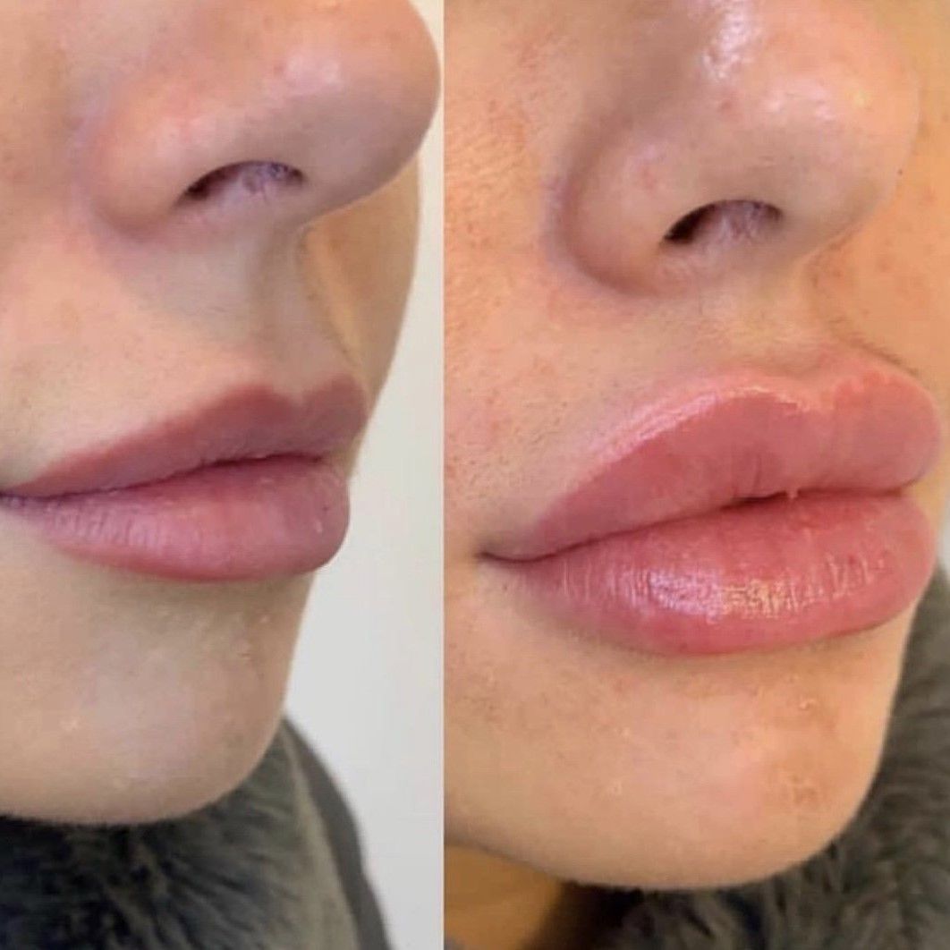 ACIDO HIALURONICO LABIOS, HIALUROPEN PALMA DE MALLORCA CENTROS MOURE (10)