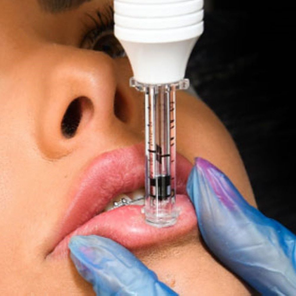 ACIDO HIALURONICO LABIOS, HIALUROPEN PALMA DE MALLORCA CENTROS MOURE (12)