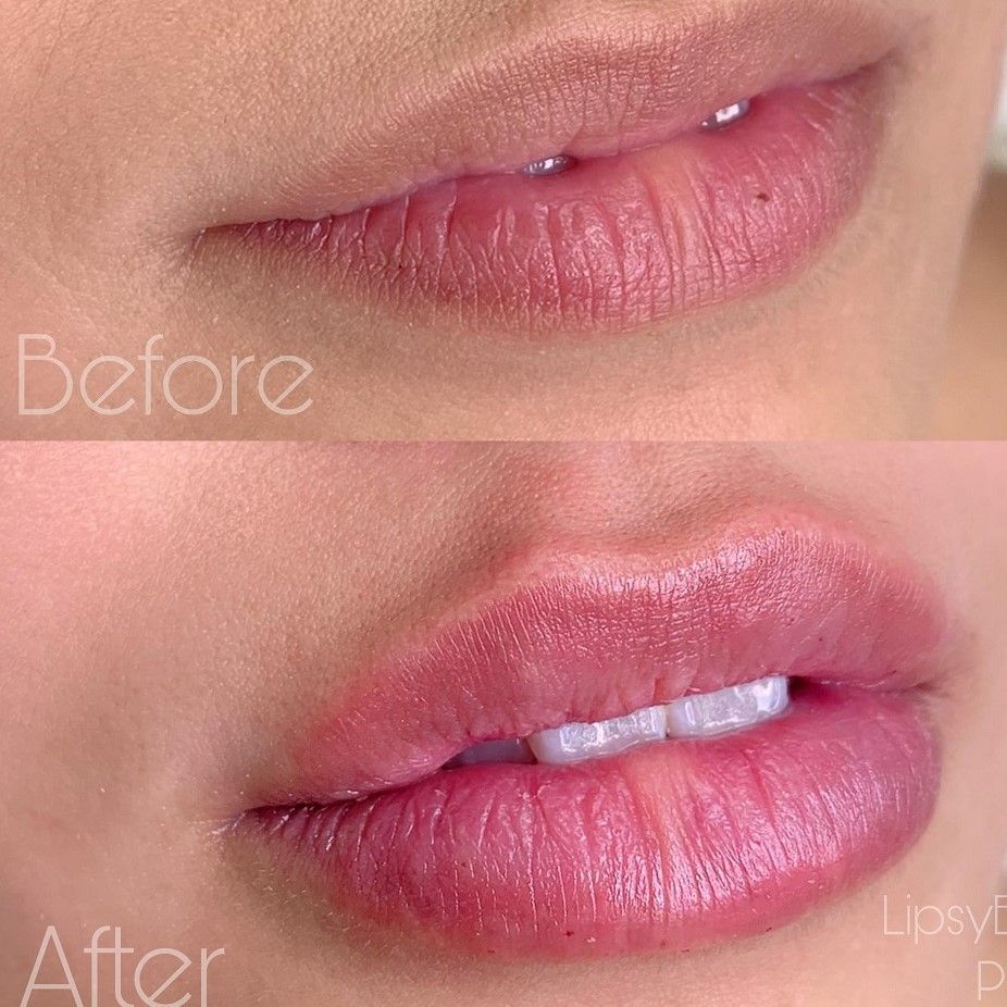 ACIDO HIALURONICO LABIOS, HIALUROPEN PALMA DE MALLORCA CENTROS MOURE (2)