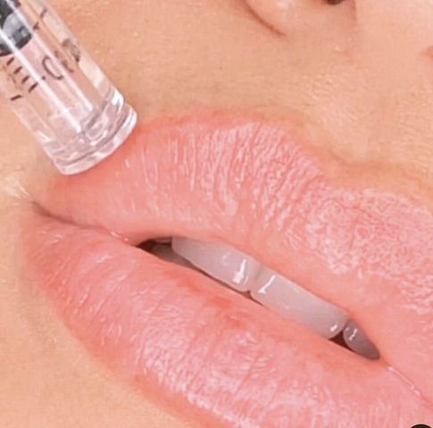 ACIDO HIALURONICO LABIOS, HIALUROPEN PALMA DE MALLORCA CENTROS MOURE (3)