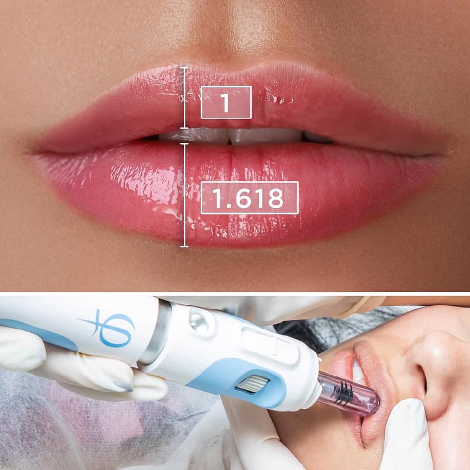 ACIDO HIALURONICO LABIOS, HIALUROPEN PALMA DE MALLORCA CENTROS MOURE (6)