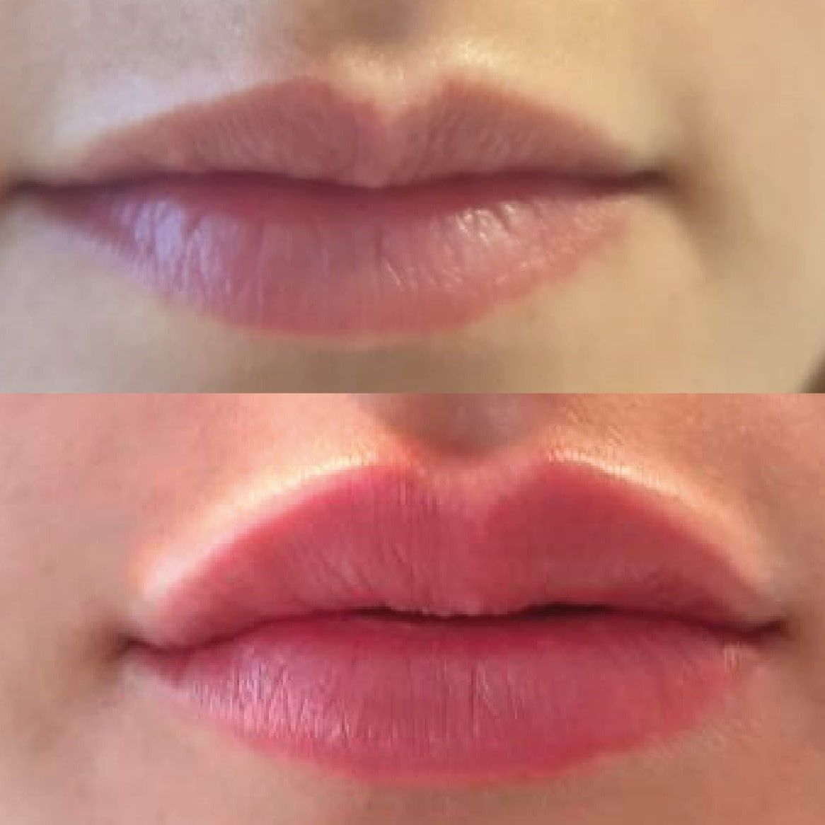 ACIDO HIALURONICO LABIOS, HIALUROPEN PALMA DE MALLORCA CENTROS MOURE (9)