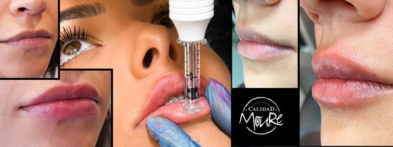 BANNER DE LABIOS CON ACIDO HIALURONICO CENTRO DE ESTETICA MOURE MALLORCA