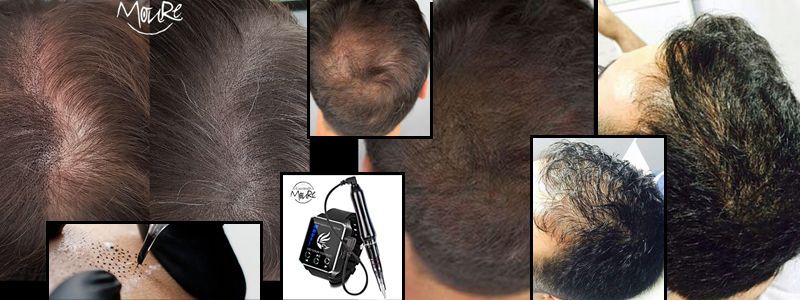 MICROPIGMENTACION CAPILAR CABELLO LARGO PALMA DE MALLORCA CENTROS MOURE BANNER