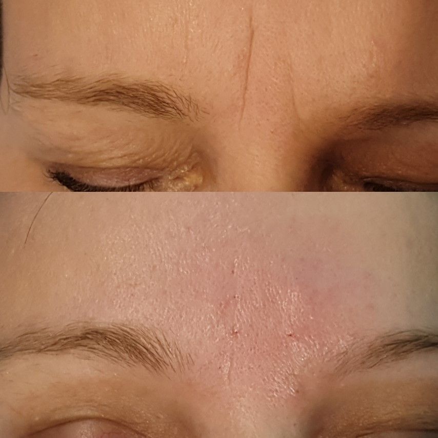 HIALUROPEN , HACIDO HIALURONICO ,ENTRECEJO Y NASOGENIANO,MALLORCA ESTETICA MOURE (4)