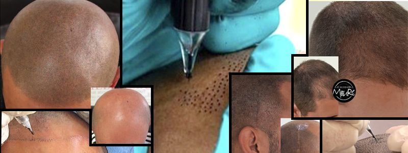 Micropigmentación Capilar. Centros Moure. OFERTA DE MICROPIGMENTACIÓN CAPILAR 290€ 1 sesión de 2 horas Técnica pelo a pelo o punteado Micropigmentación Capilar. Centros Moure. OFERTA DE MICROPIGMENTACIÓN CAPILAR 290€ 1 sesión de 2 horas Técnica pelo a pelo o punteado