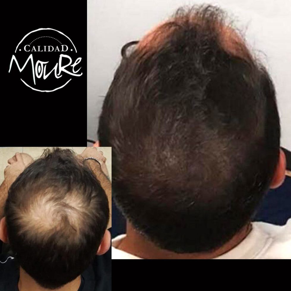 Micropigmentación Mallorca. Centros Moure. OFERTA DE MICROPIGMENTACIÓN CAPILAR 290€. 1 sesión de 2 horas. Técnica pelo a pelo o punteado.