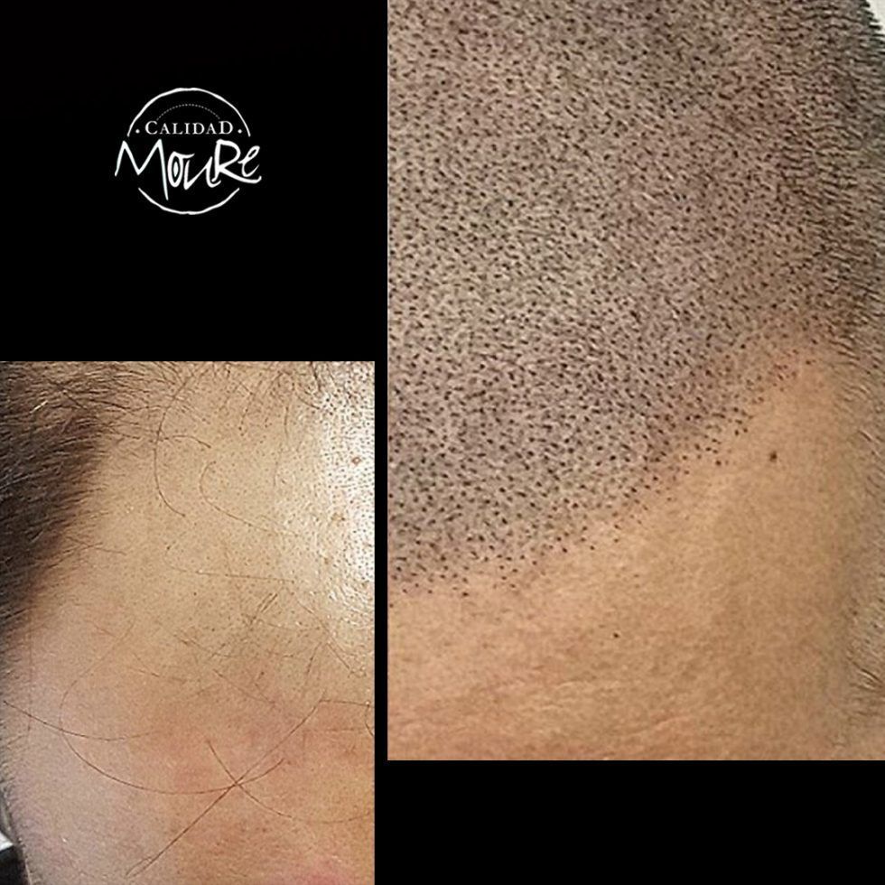 Micropigmentación Mallorca. Centros Moure. OFERTA DE MICROPIGMENTACIÓN CAPILAR 290€. 1 sesión de 2 horas. Técnica pelo a pelo o punteado.